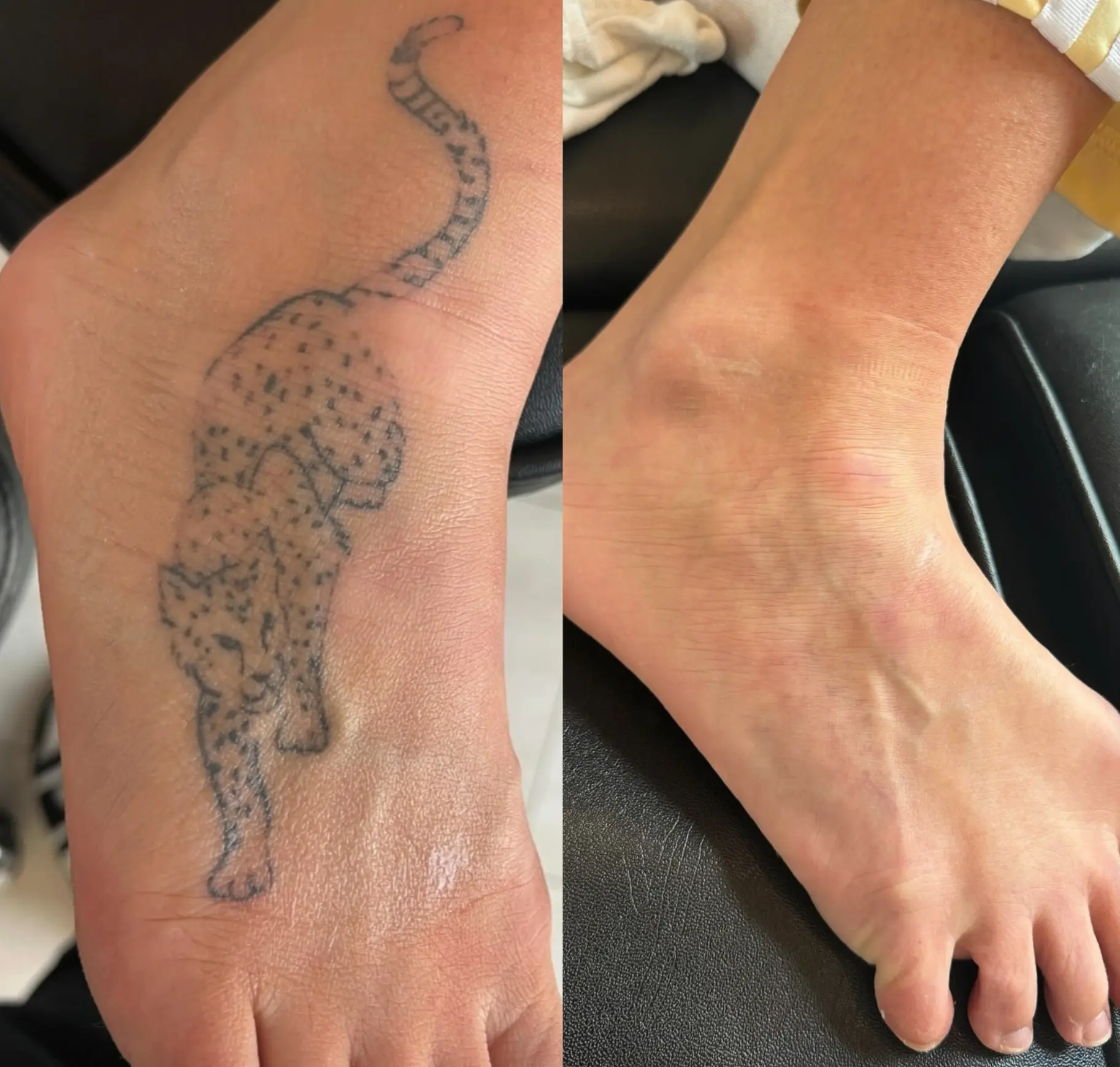 What Does a Level 5 Tattoo Removal Course Involve