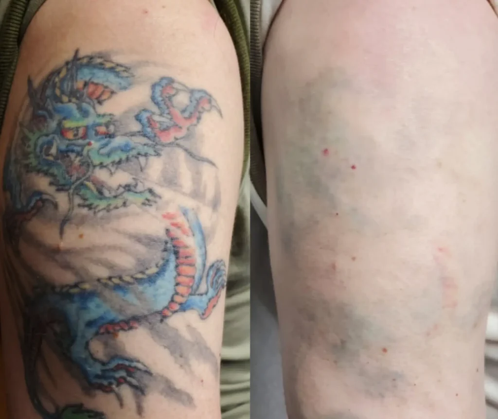 laser tattoo removal