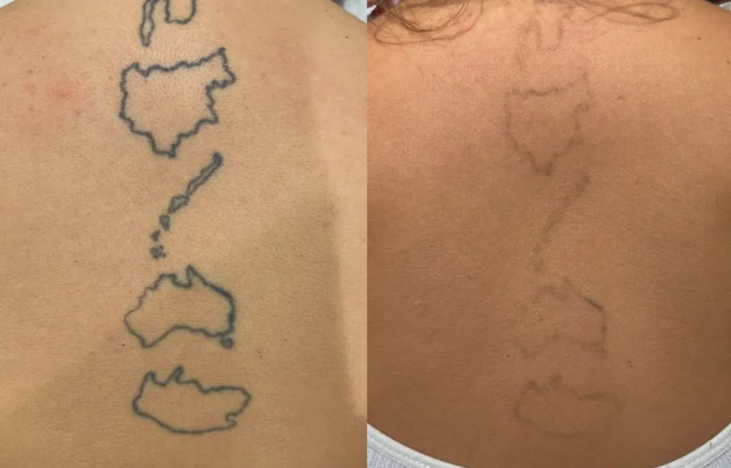tattoo removal